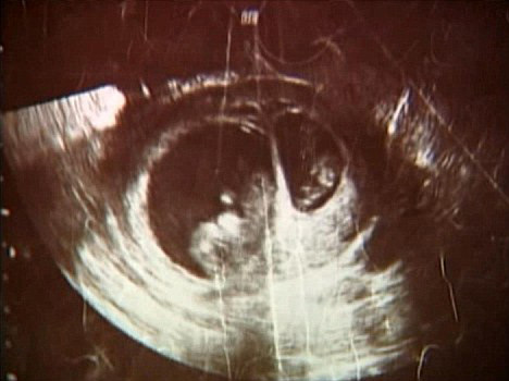 حالة نادرة لأمريكية.. "حمل خلال الحمل"!! حالة نادرة لأمريكية.. "حمل خلال الحمل"!!
