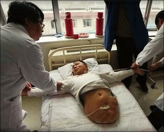 بعد استئصال نصفه افتتح متجر نصف رجل بنصف السعر! بعد استئصال نصفه افتتح متجر نصف رجل بنصف السعر!