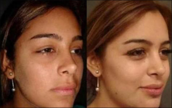 بالصور.. العارضة لاريسا قبل وبعد عمليات التجميل! بالصور.. العارضة لاريسا قبل وبعد عمليات التجميل!