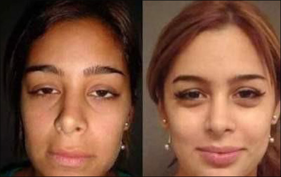 بالصور.. العارضة لاريسا قبل وبعد عمليات التجميل! بالصور.. العارضة لاريسا قبل وبعد عمليات التجميل!