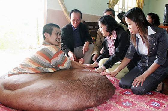 بعد ان خرج نموه عن السيطرة.. استئصال ورم هائل من ساق رجل!