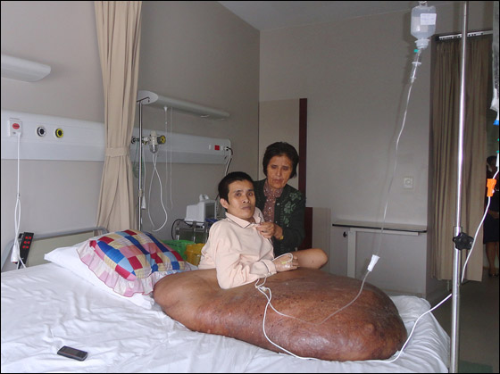 بعد ان خرج نموه عن السيطرة.. استئصال ورم هائل من ساق رجل!