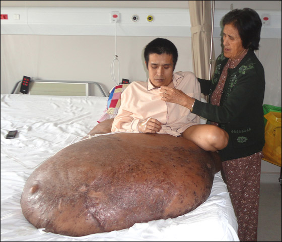 بعد ان خرج نموه عن السيطرة.. استئصال ورم هائل من ساق رجل!