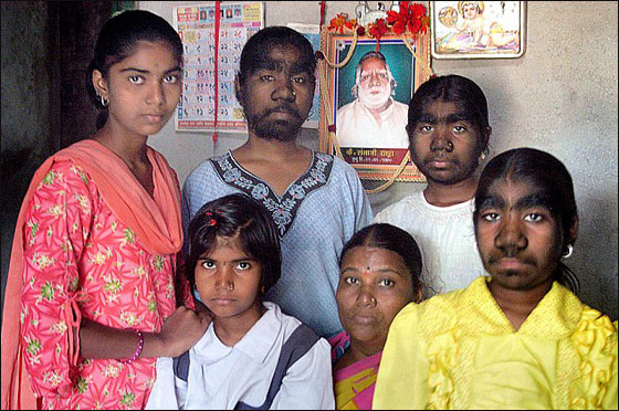 مؤثر.. قصة ثلاث شقيقات هنديات يعانين من متلازمة الذئب! 