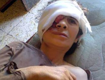 حالة مرضية غريبة: جزائرية مصابة بورم ينهش وجهها! حالة مرضية غريبة: جزائرية مصابة بورم ينهش وجهها!
